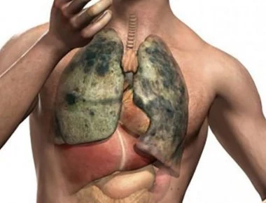 Αυτά είναι τα σημάδια που δείχνουν πιθανό καρκίνο του πνεύμονα!